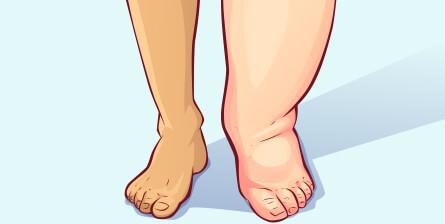 Edema, linfedema, lipedema: cosa significano davvero le gambe grosse?