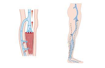 Come funziona il Circolo Venoso degli Arti Inferiori.