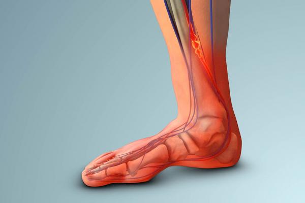 Come favorire il ritorno venoso gambe: i benefici delle calze a compressione per la valvulopatia