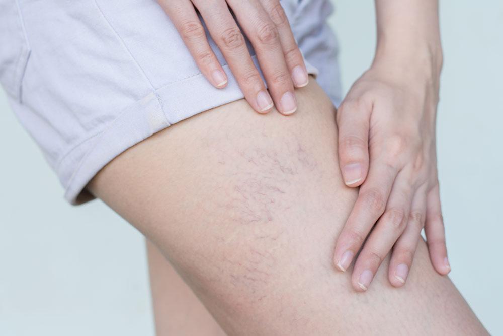 Calze per flebite: perché utilizzare le calze a compressione? Vantaggi e consigli utili