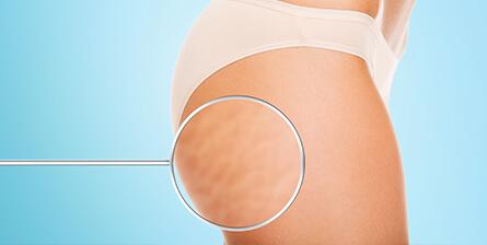 La Cellulite: cos’è e come si tratta?