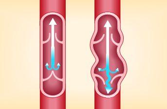 Come cambia lo scorrimento del sangue nell’insufficienza venosa?