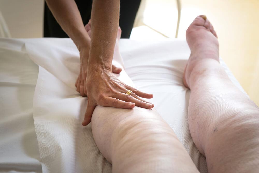 gambe gonfie e perdita di liquido Edema venoso e linfatico e lipedema: quali sono le differenze